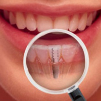 implant dentaire au cabinet dentaire le Beaufay